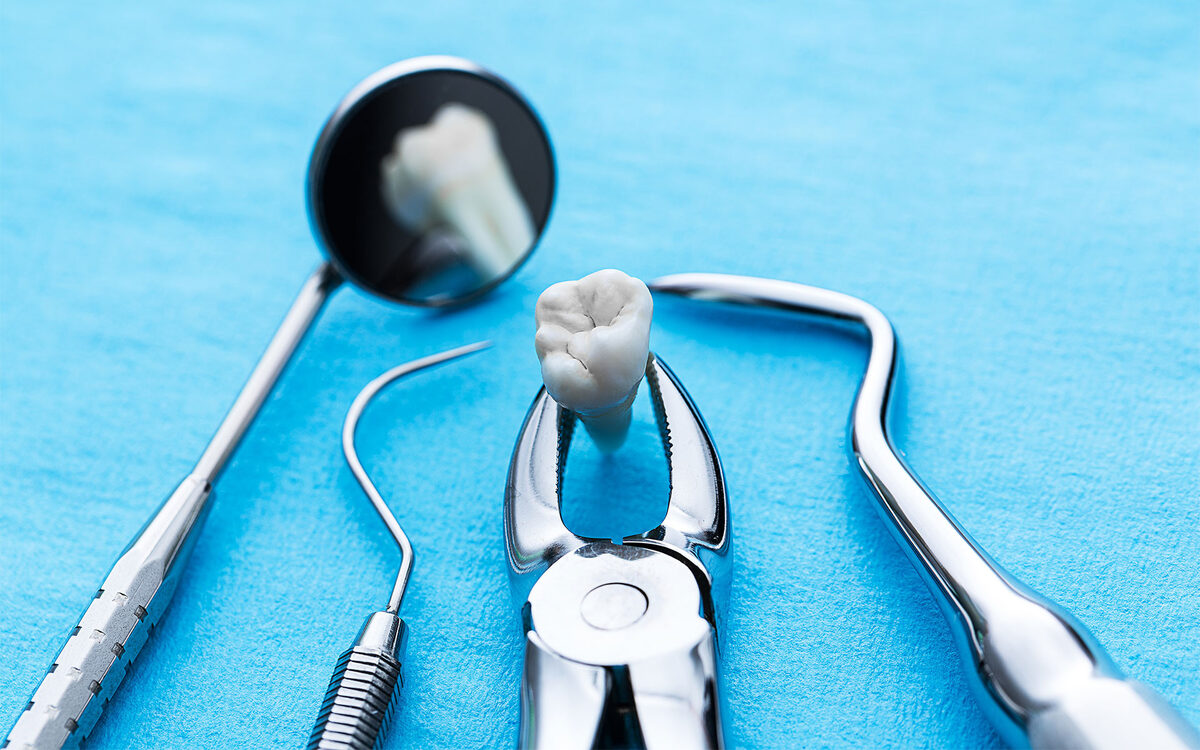 имплантация зубов в Чебоксарах, удаление зуба