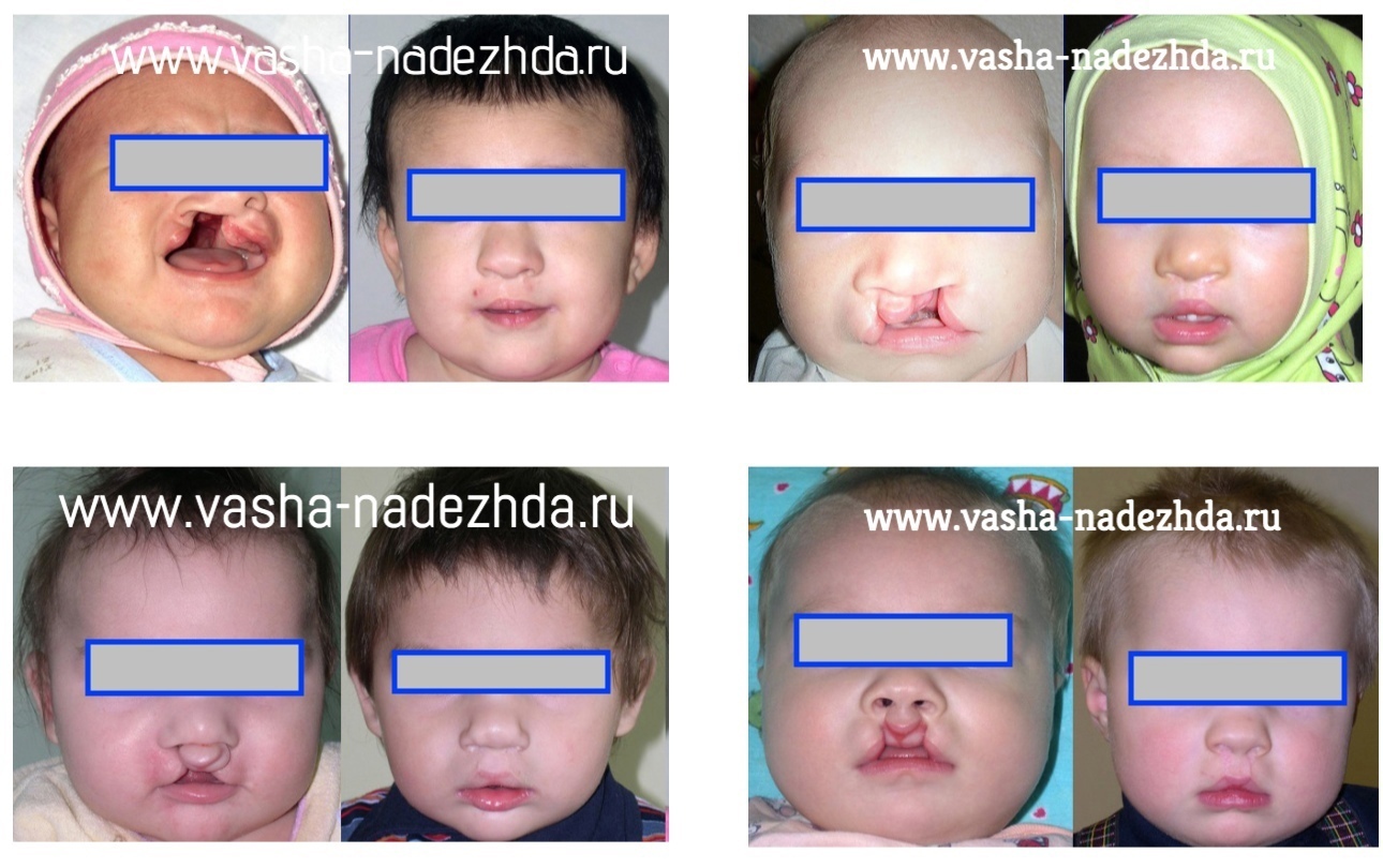 Трясется нижняя губа у новорожденного — 6 ответов | форум Babyblog