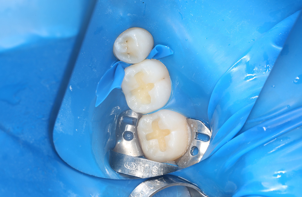 Пломбирование зубов подростку с использованием композита Harmonize A2