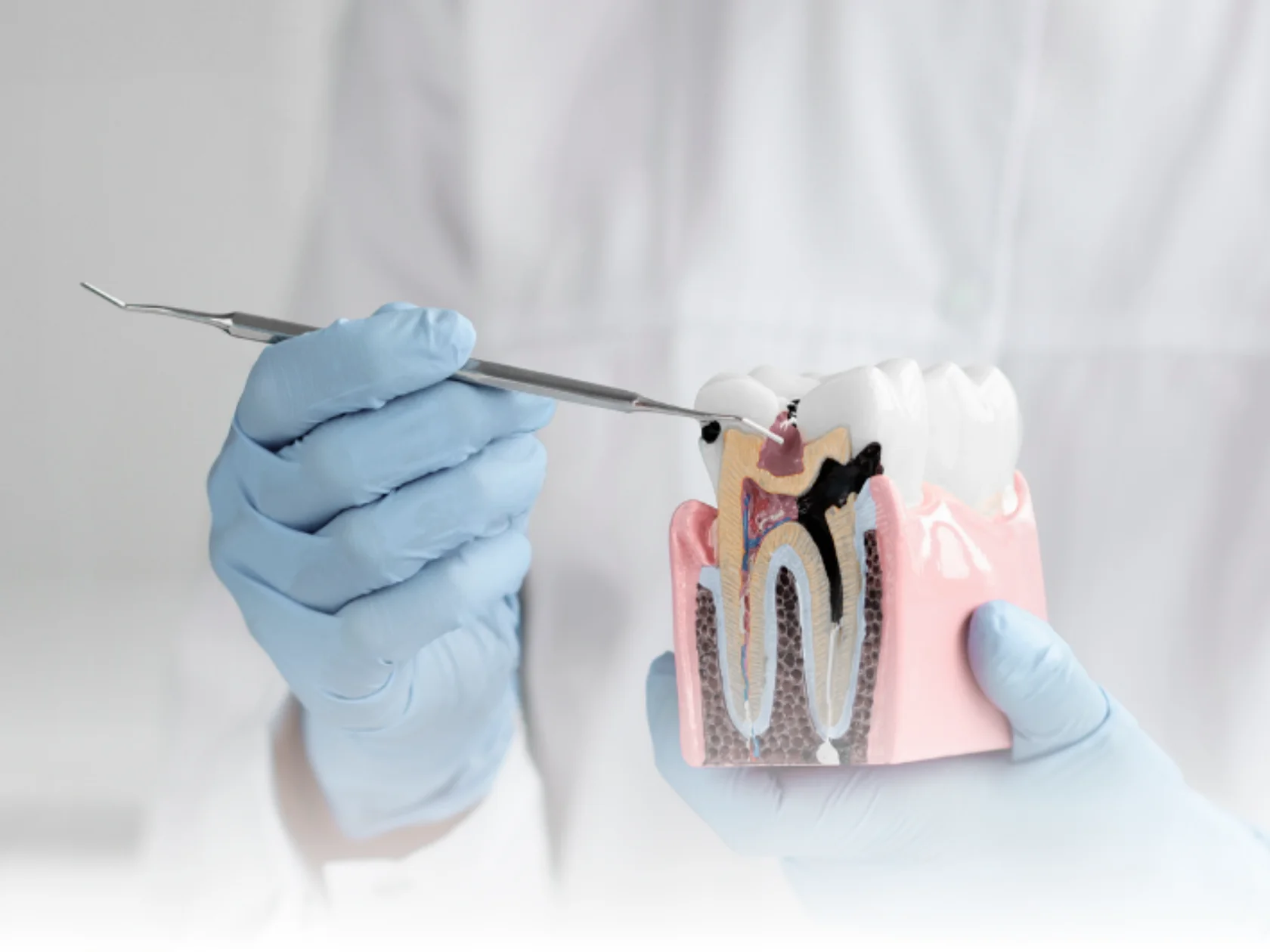 Стоматолог в перчатках демонстрирует на анатомической модели зуба развитие кариеса и его осложнений, подчёркивая важность своевременного лечения в Минске.