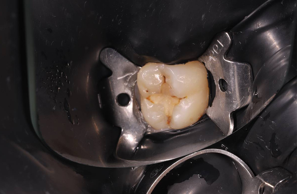 Своевременное лечение повторного кариеса с заменой несостоятельной пломбы