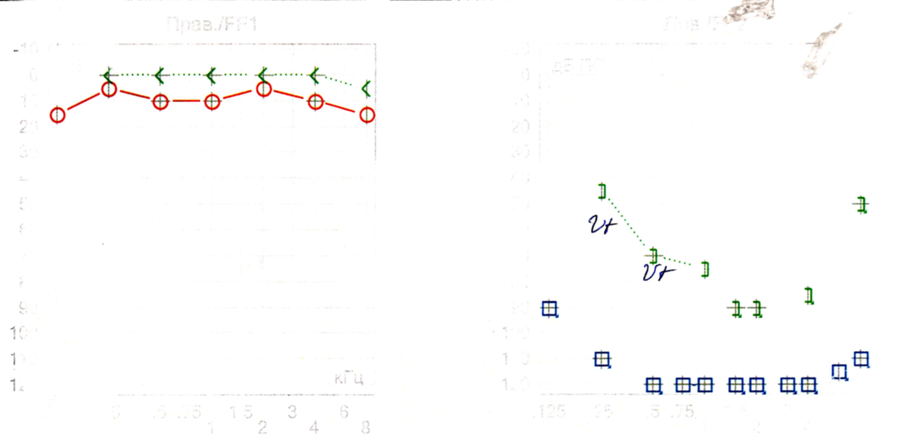 аудиограмма, глухота