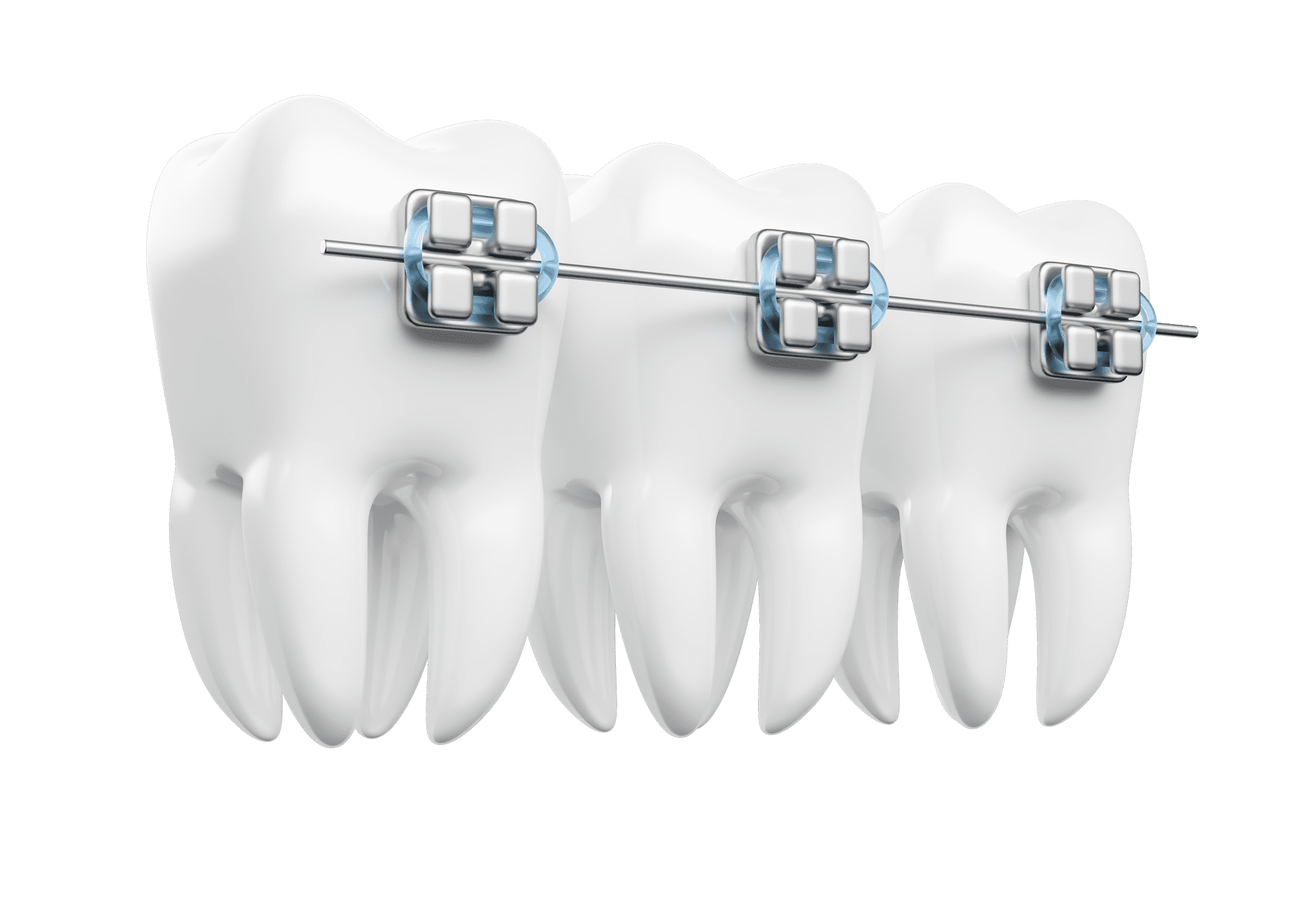 Установка брекетов в Тамбове