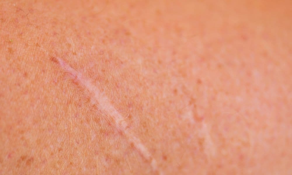 Linear Scars