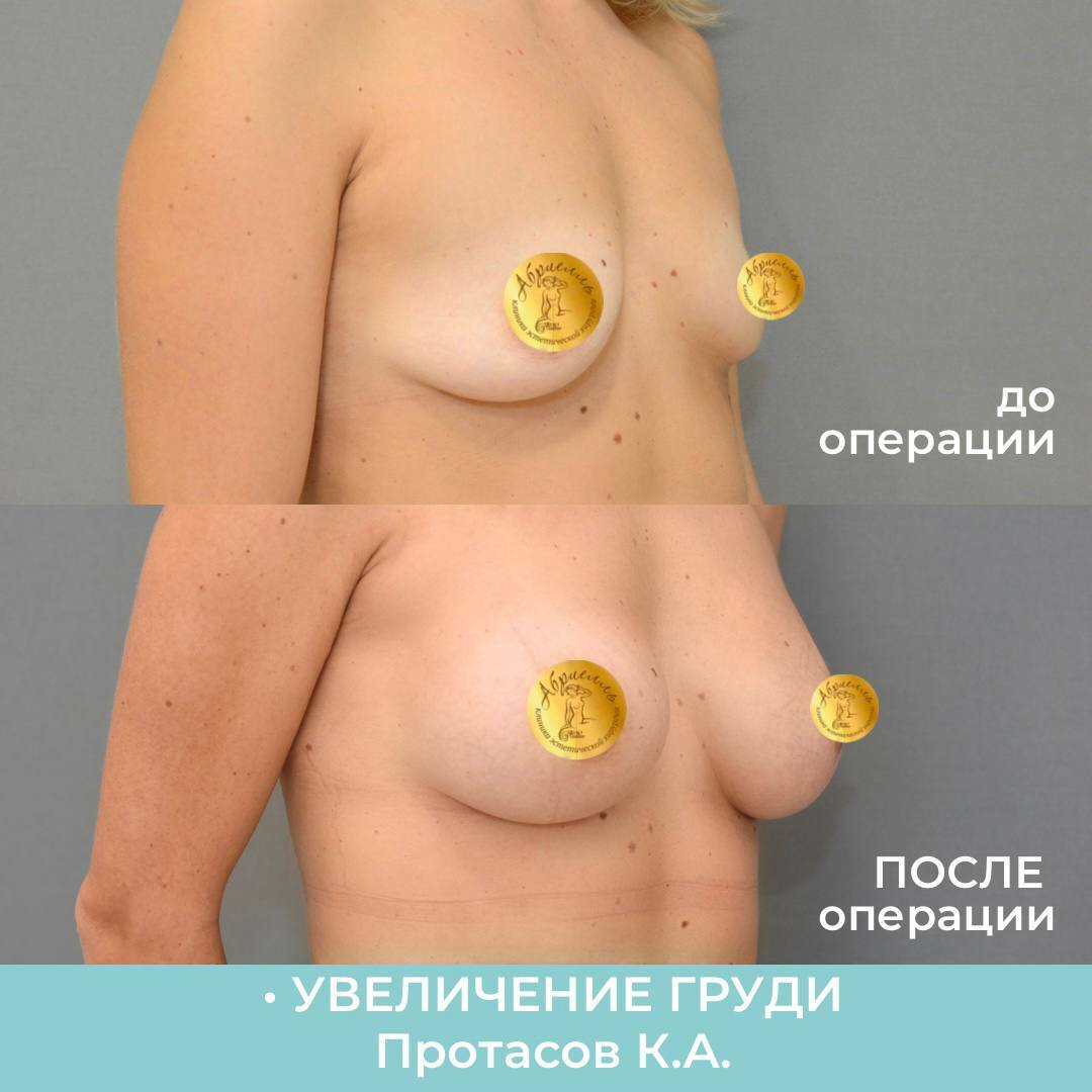 при беременности может увеличиться только одна грудь фото 24