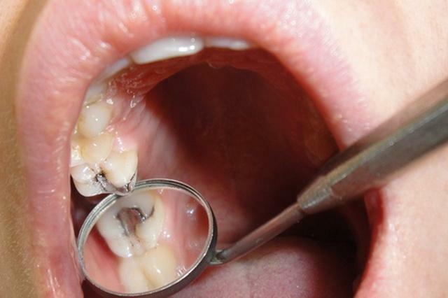 Почему от сладкого портятся зубы — FDC Французская стоматологическая клиника