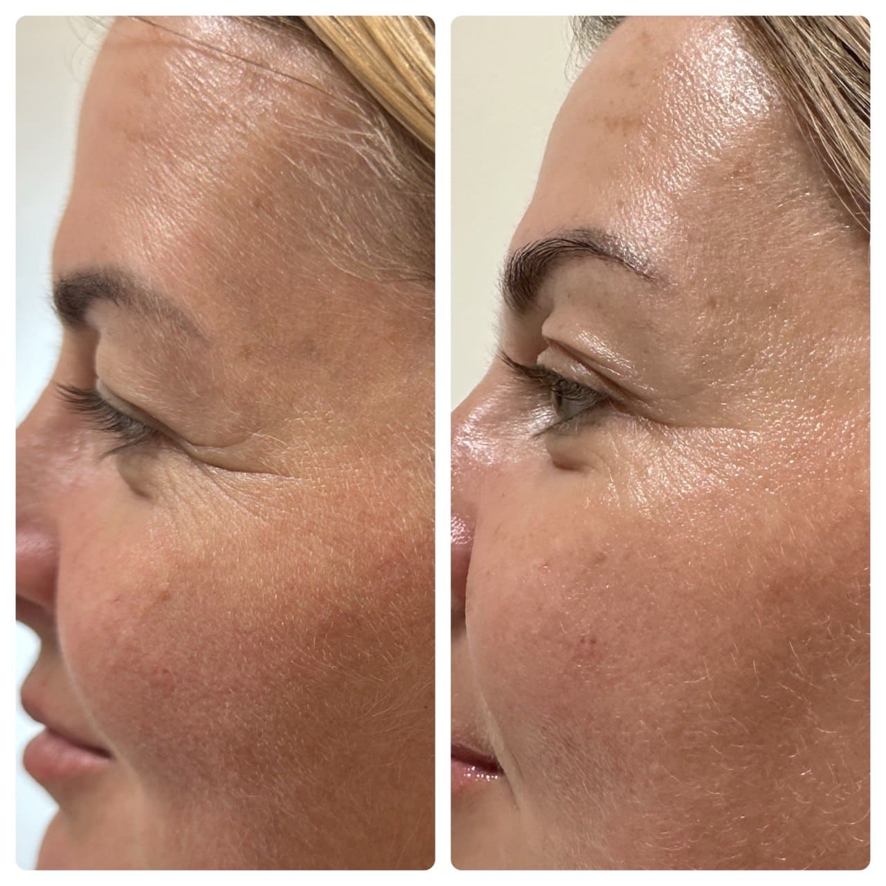 RF Microcurrent Facial before and after skin lifting Beauty Studio by Hanna Mount Pleasant SC