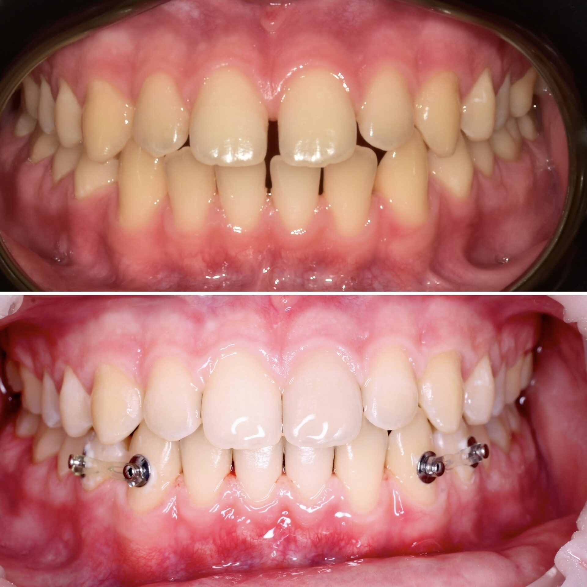 брекеты чебоксары,брекеты йошкар ола,исправление зубов в чебоксарах, исправление зубов москва