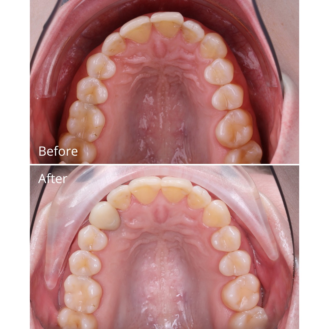 After photo showing corrected midline and a symmetrical, harmonious smile — photo 3 of 3