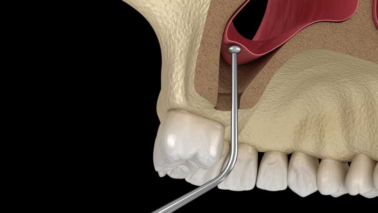 Синус лифтинг — цены в Дербенте. Стоматология DK