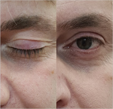 Купить аппарат холодной плазмы для косметологии и личного использования.