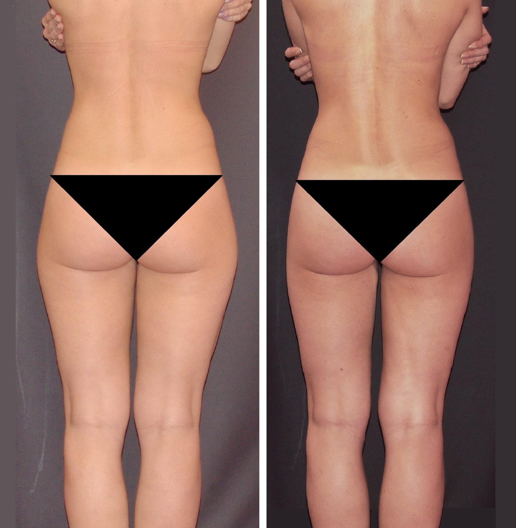 Ручная липосакция массаж фото до и после
