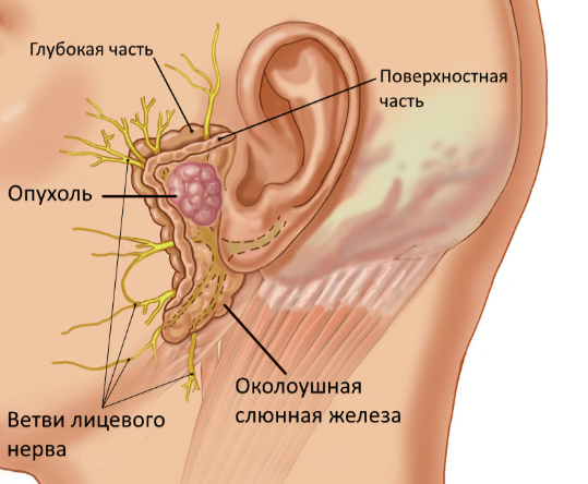 Опухоли слюнных желез: причины и лечение