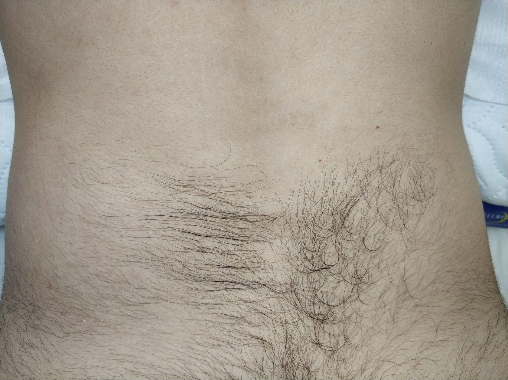 удаления волос на груди у мужчин навсегда фото 75