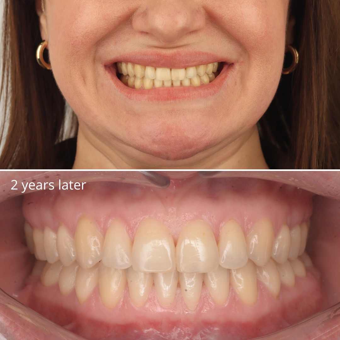 After photo showing closed diastemas and a stable Class III correction — photo 5 of 5