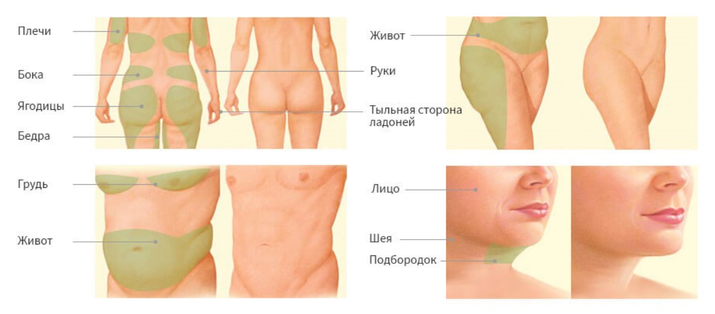 Схема уколов липолитика в лицо