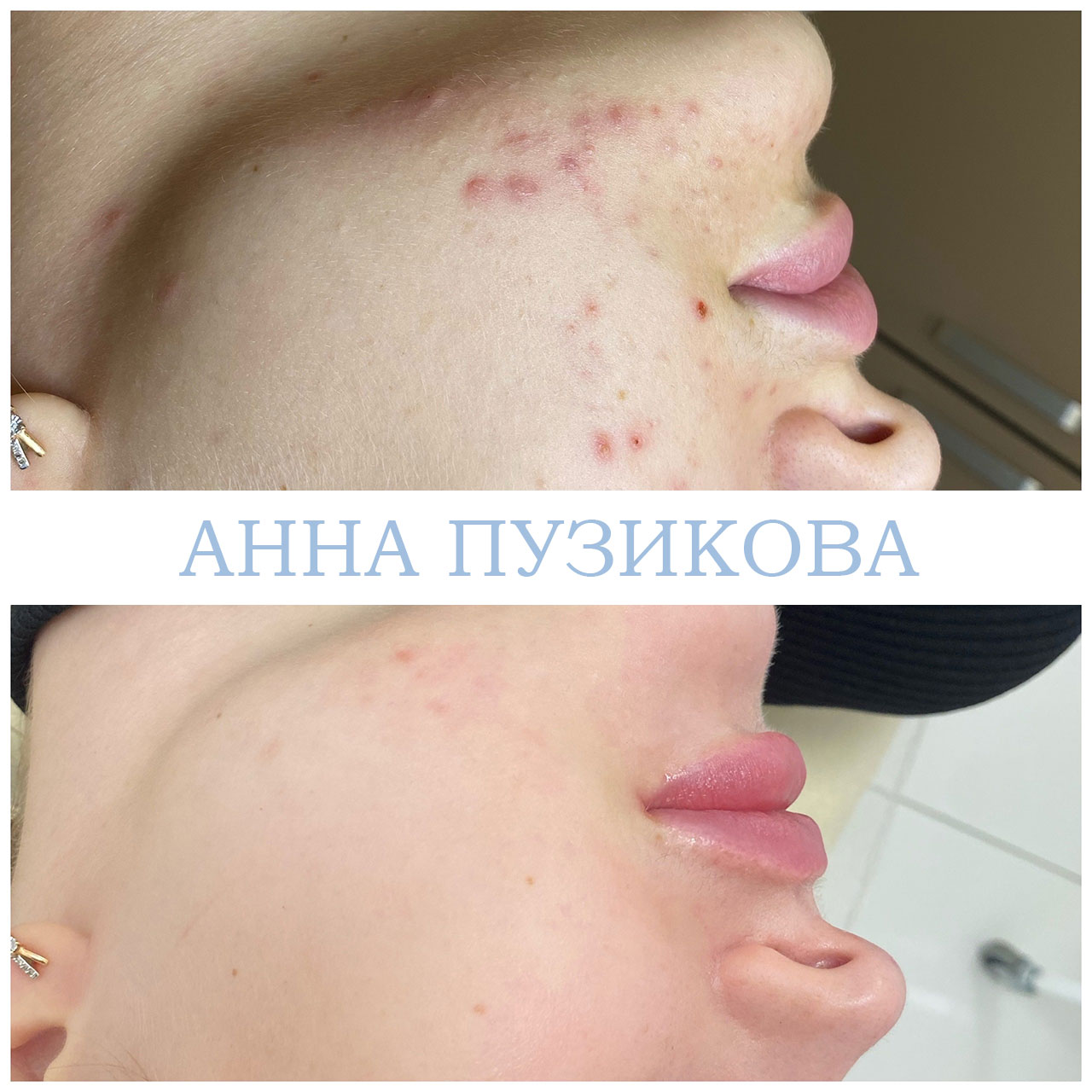 Результат лечения акне и воспалений кожи после курса процедур у косметолога Анны Пузиковой в клинике Прадус (СПб).