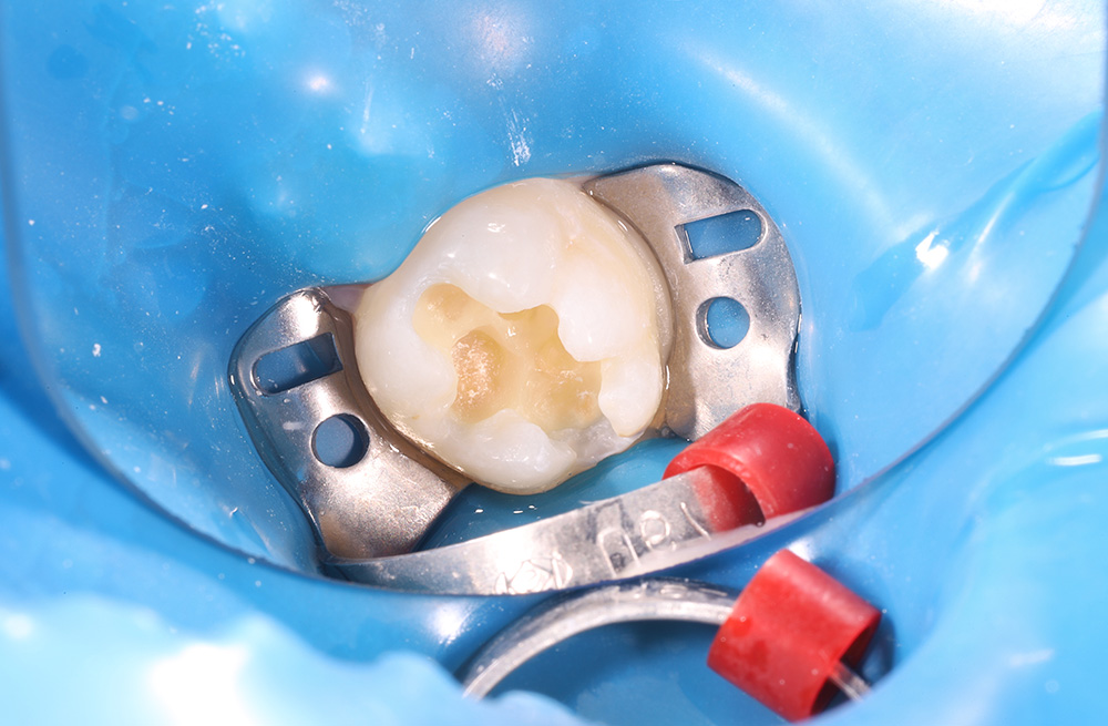 Восстановление зуба подростку при кариесе дентина пломбировочным материалом Harmonize A2