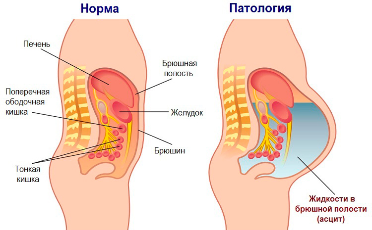 Чем опасна послеоперационная грыжа