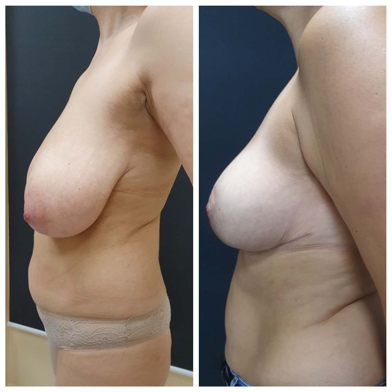 упражнение для уменьшения груди у женщин фото 54