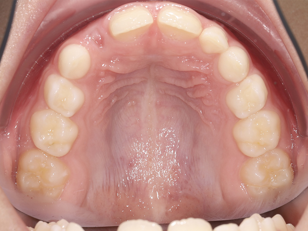 Исправление глубокого прикуса с установкой съемной ортодонтической пластинкидля правильного развития челюстей