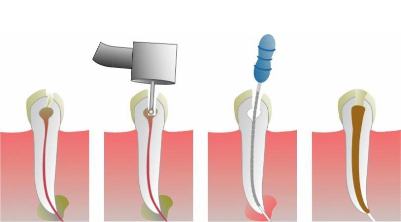 Endodoncia como se hace