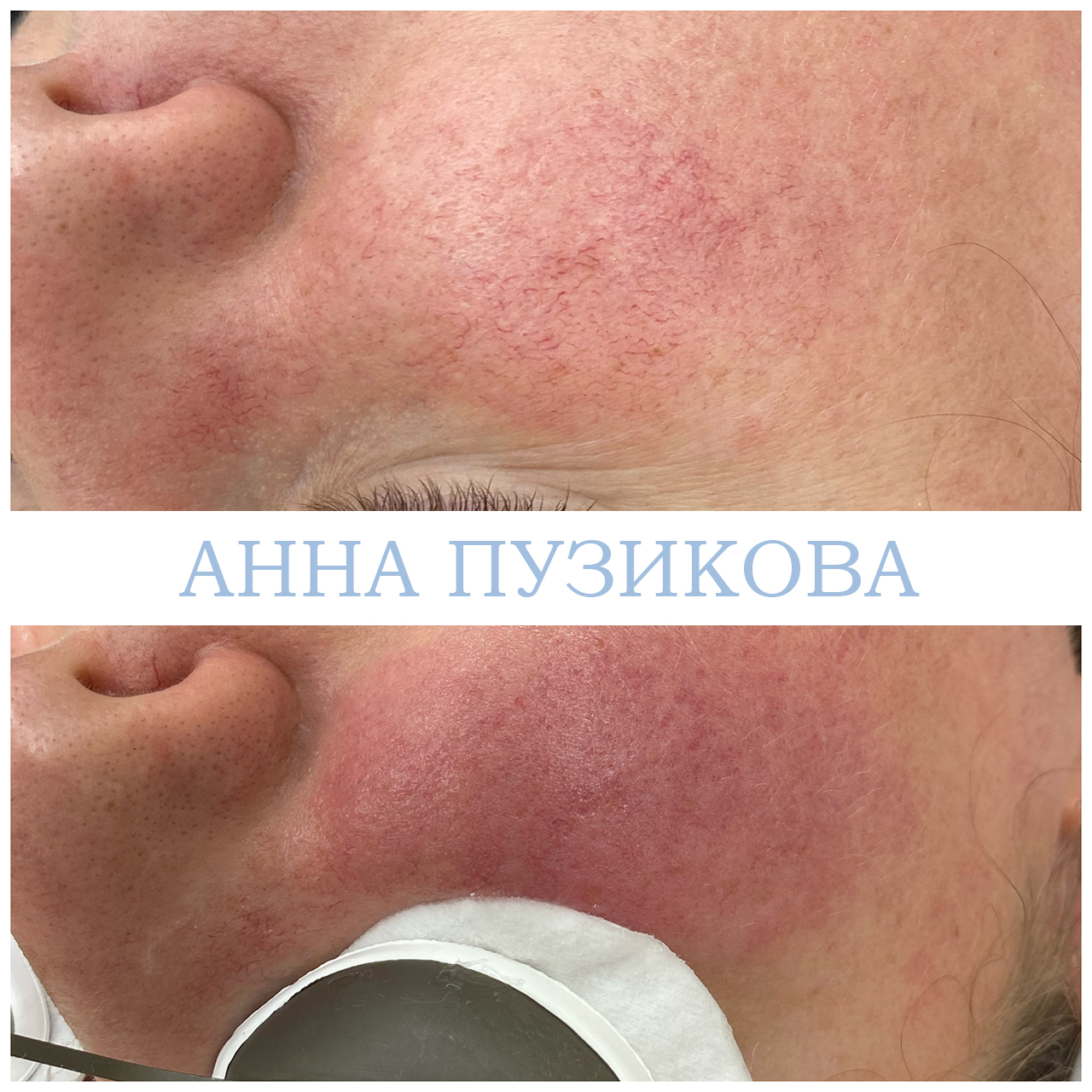 Результат удаления сосудистых звёздочек и купероза на лице с помощью фототерапии ClearLight IPL — врач-косметолог Пузикова Анна Анатольевна, Санкт-Петербург