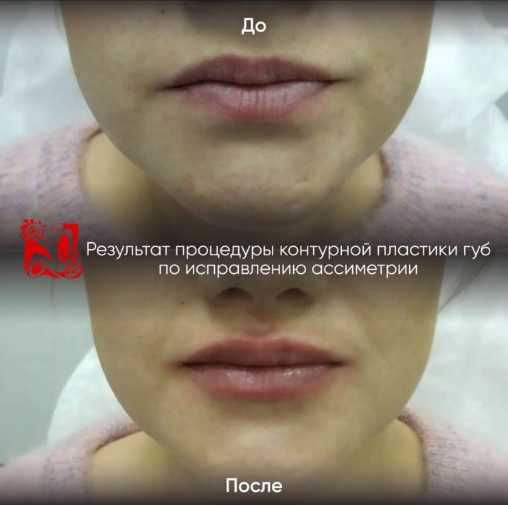 Контурная пластика — фотография 6 из галереи клиники «Эстетика»
