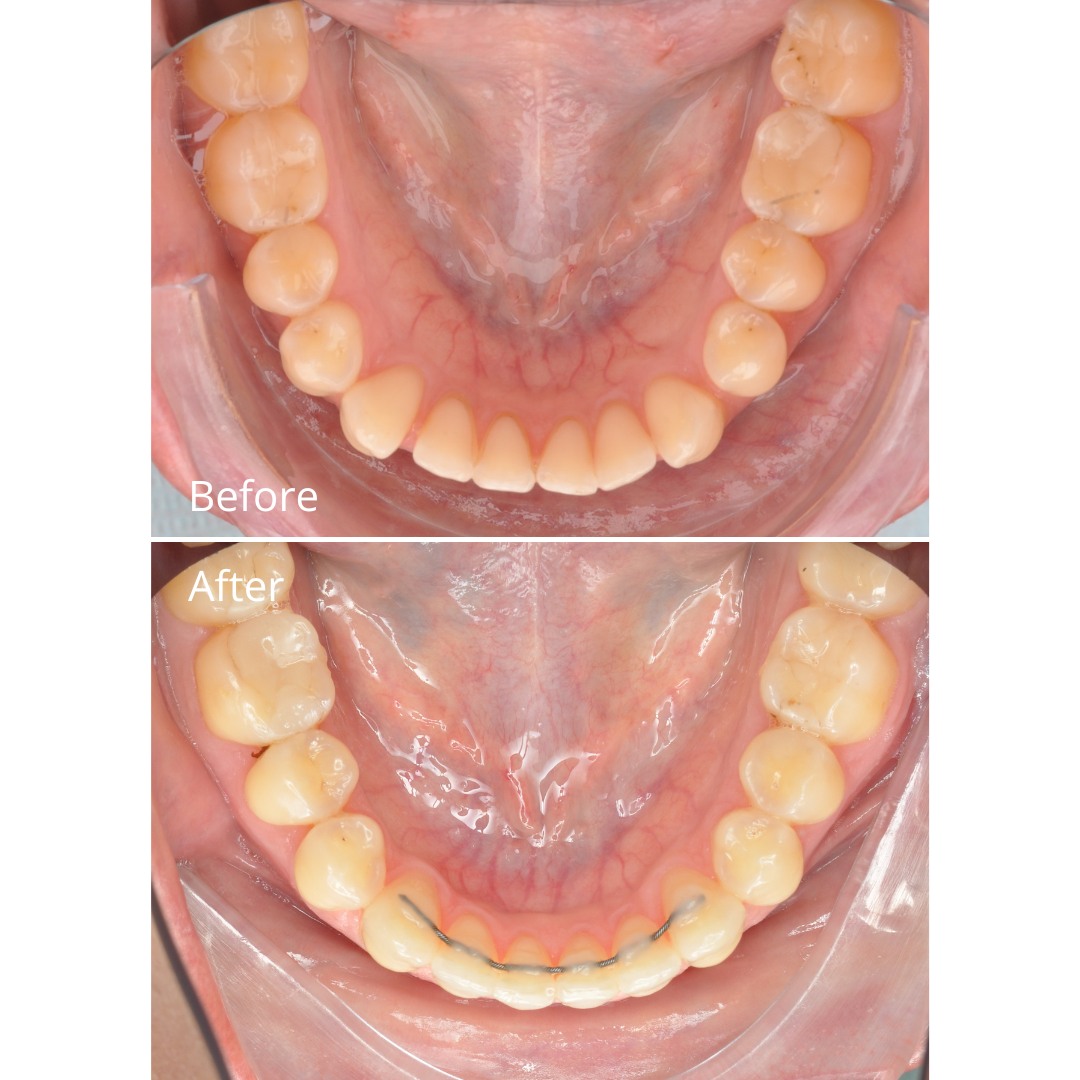 Stage photo showing continued protrusion and inclination correction — photo 4 of 5