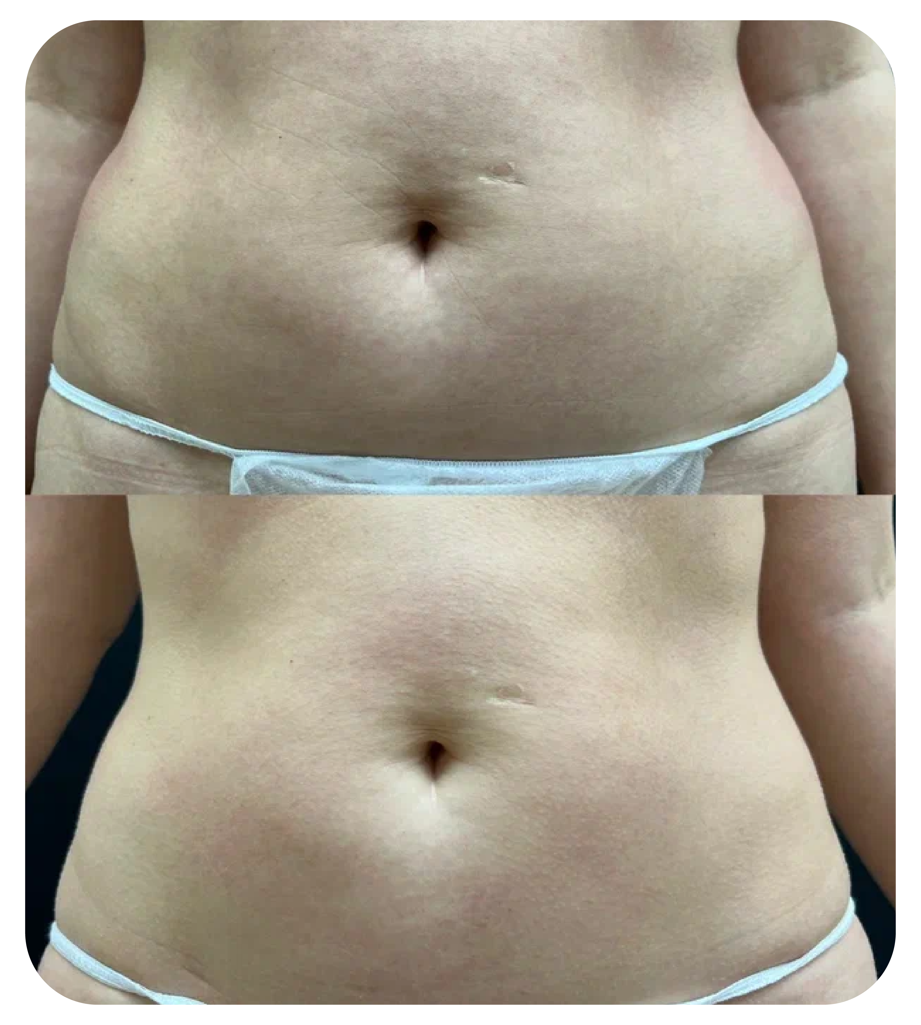 липолиз до после