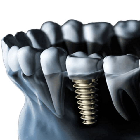 Лечение кариеса зубов в клинике доктора Барышева