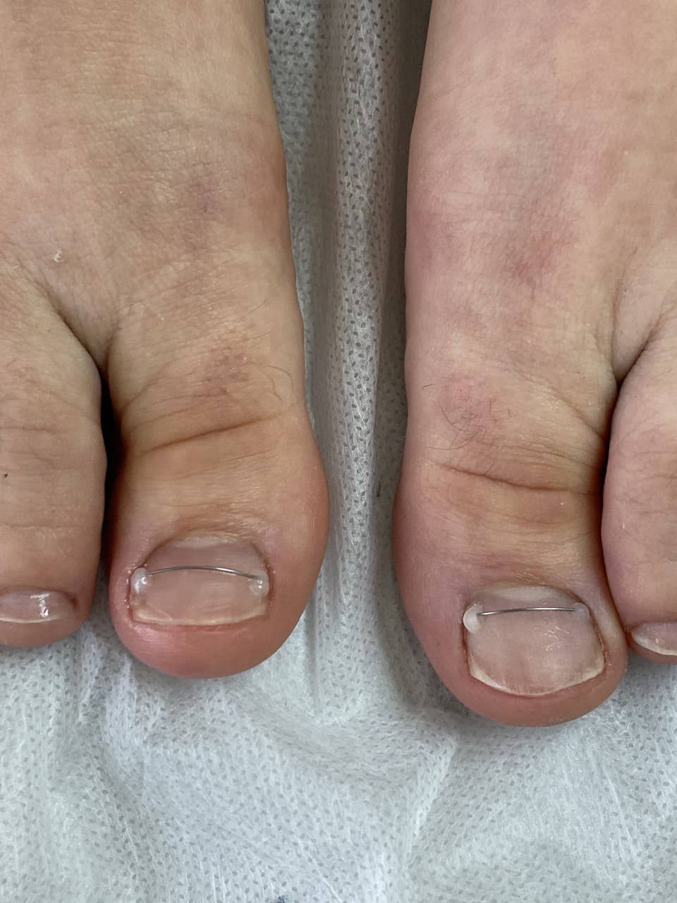 Титановая нить