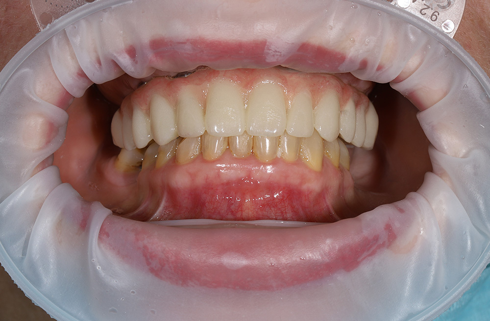 Установка имплантов на верхнюю челюсть по хирургическому шаблону