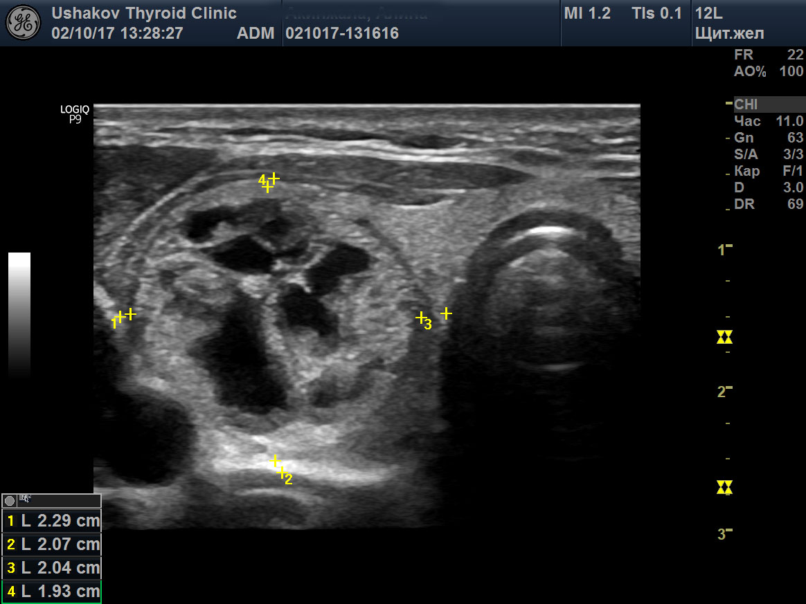 Семейное узи. Ушаков УЗИ щитовидной железы. УЗИ щитовидной железы подготовка. Наглядные примеры УЗИ. Аденома щит железы УЗИ примеры.