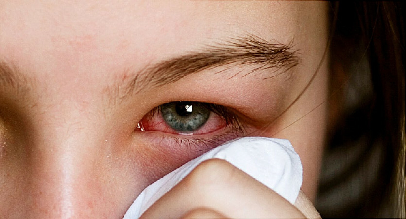 Угрожал глаза. Лимбальный кератоконъюнктивит. Токсико аллергический кератоконъюнктивит.