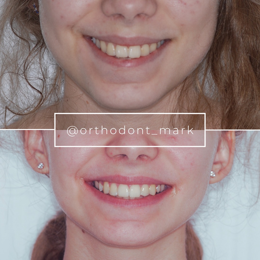 Deep Bite and Incisor Protrusion Corrected With Extraction