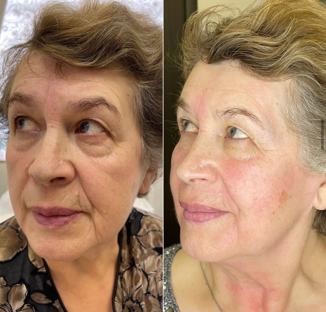 Vl препарат. Пластика нижнего века. Вл77. Vl26g. Пептиды vl26g отзывы.