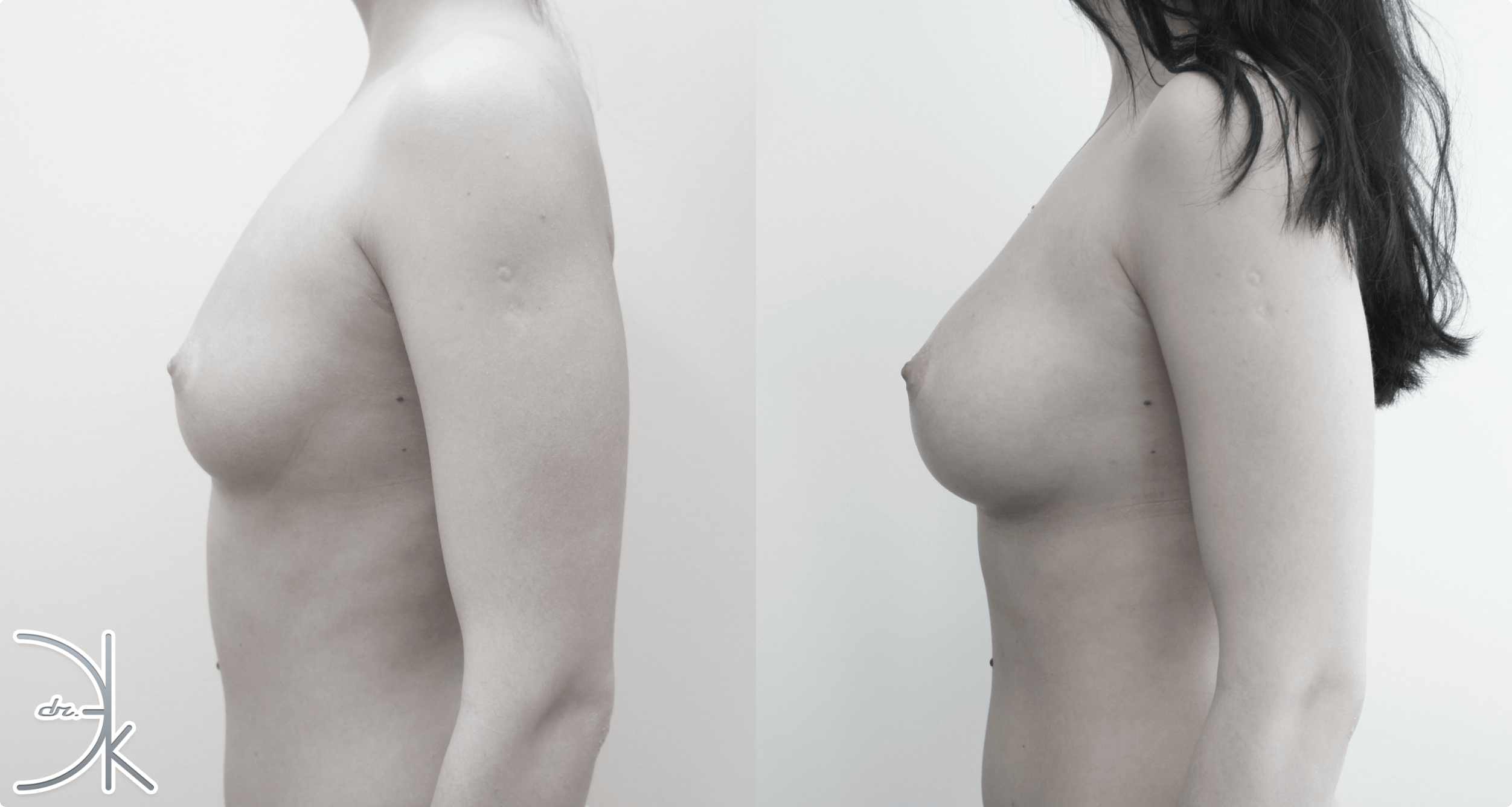 липосакции груди у женщин фото 68