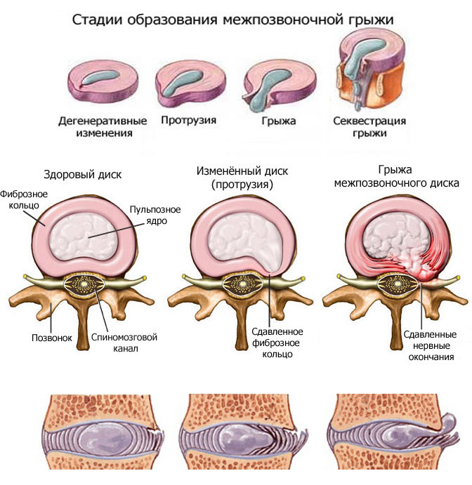 Грыжа межпозвонковых дисков презентация