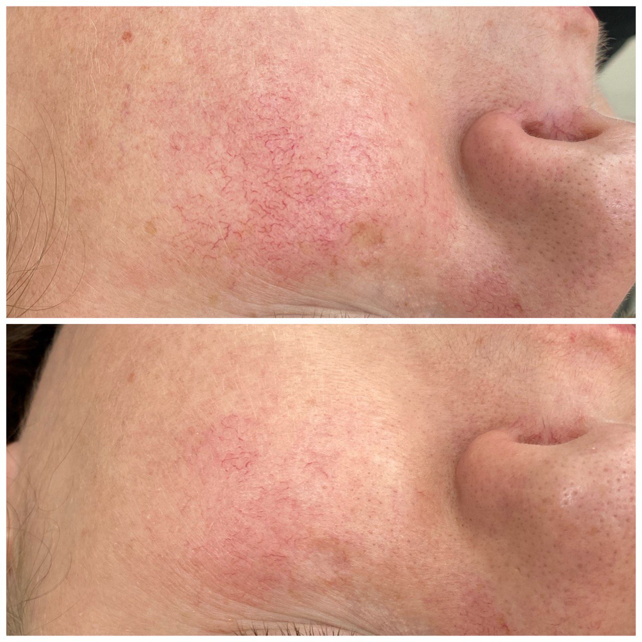 Фото до и после: удаление сосудов лазером в клинике PradusCOSMO, Санкт-Петербург. Безопасно, эффективно и без повреждений кожи