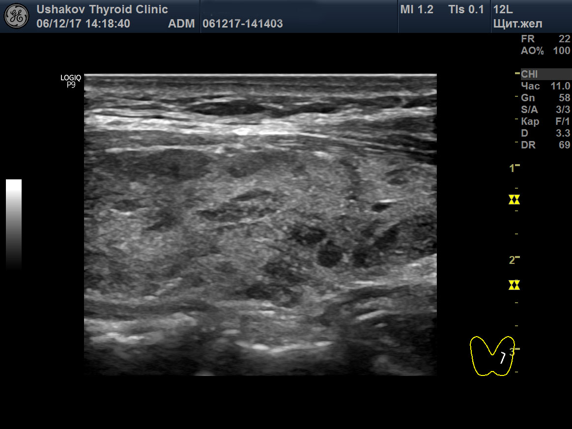 Уз картина диффузных изменений паренхимы щитовидной железы