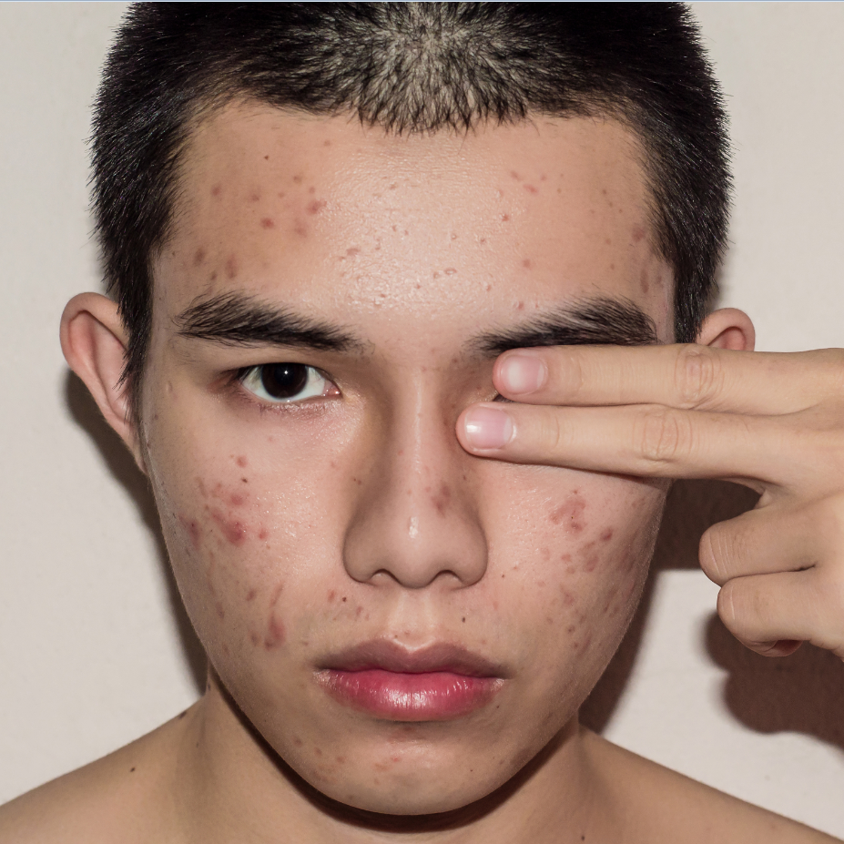 Как бороться с акне?