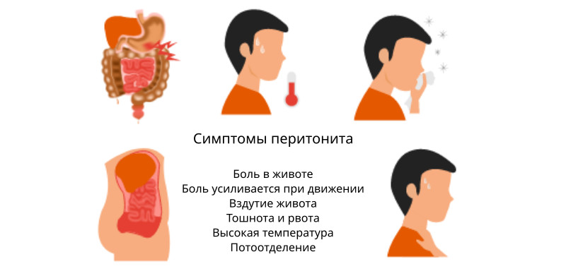 Перитонит это симптомы у взрослых. Перитонит это симптомы у взрослых
