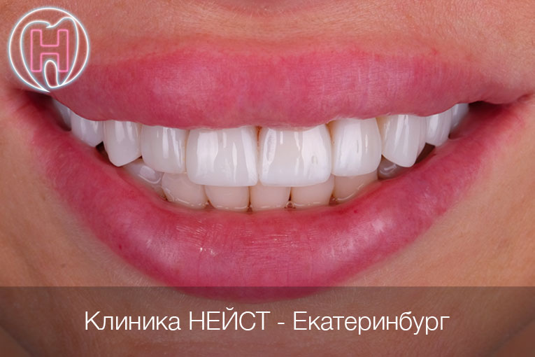 композитные виниры Премиум в Екатеринбурге, цвет Блич 3