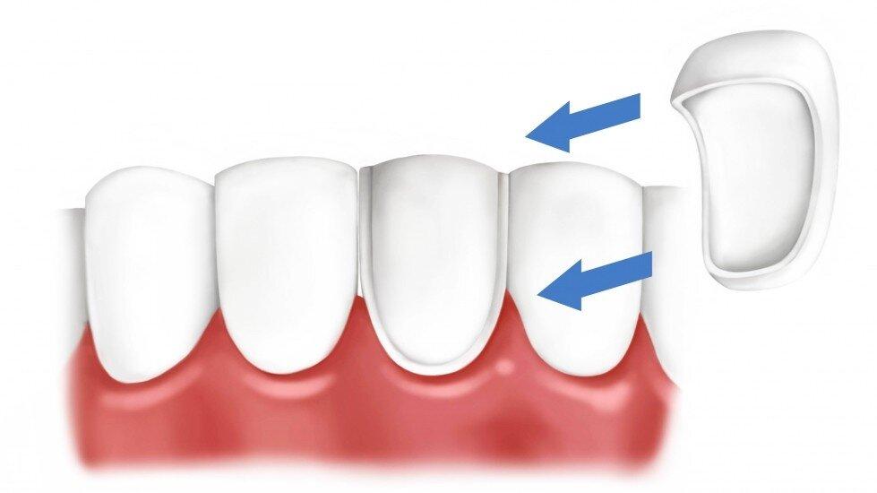 Композитные виниры. Керамокомпозитные виниры. Виниры люминиры микропротезы. Прямые композитные виниры. Прямые виниры из композитного материала.