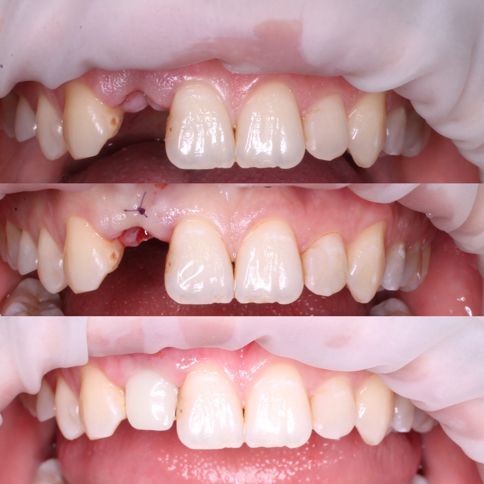 имплантация зубов в Чебоксарах,Йошкар-оле,имплантация,акция на имплантацию зуба,рассрочка на имплантацию