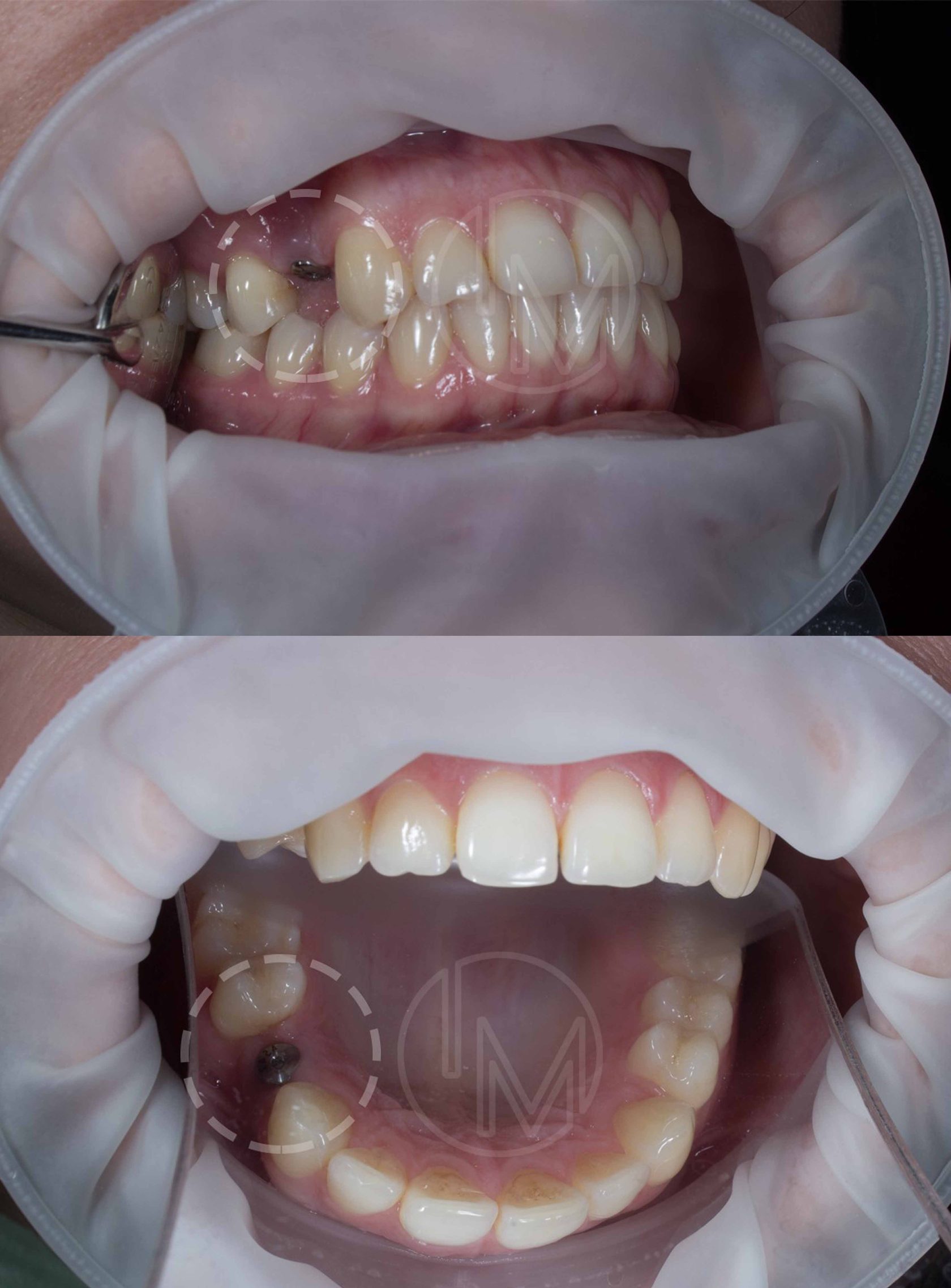 Импланты в бедра фото до и после