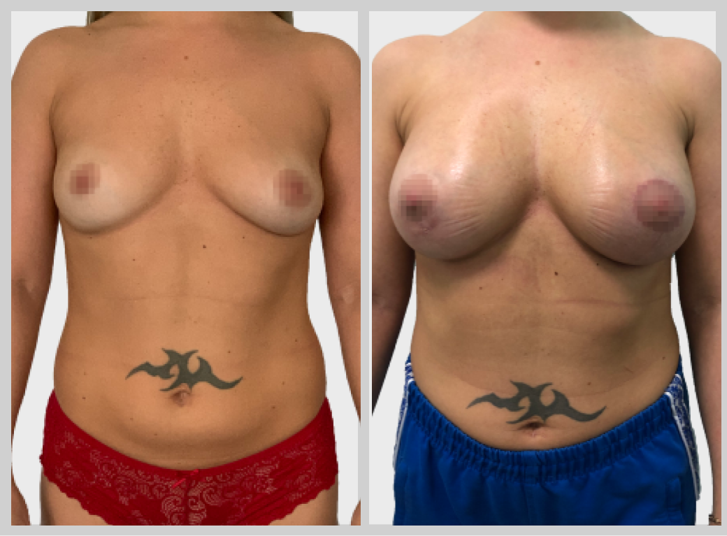 маммопластика увеличение груди импланты