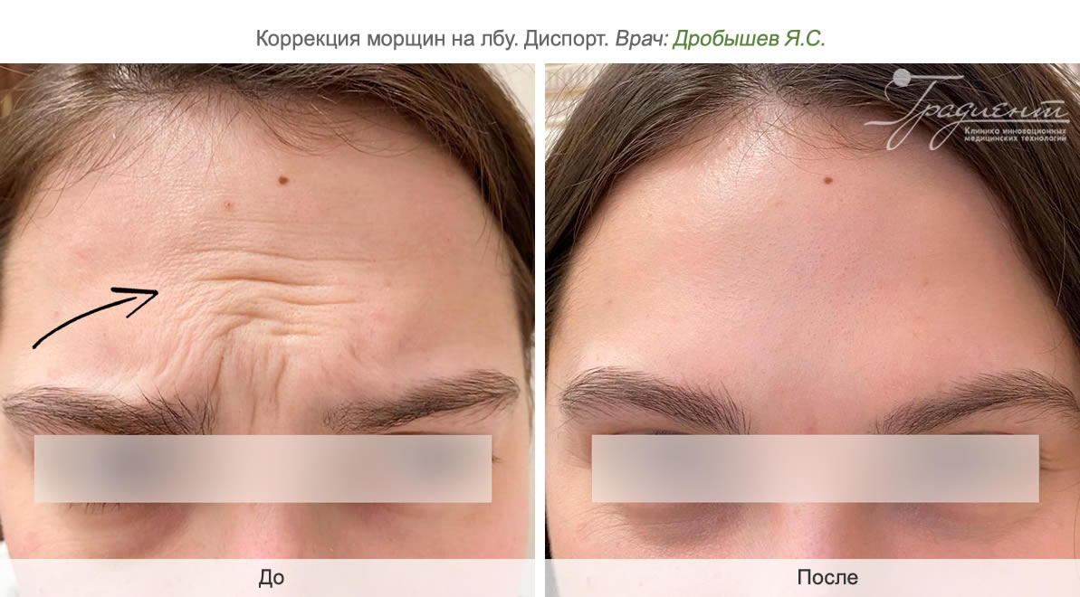 Удаление мимических морщин на лбу в клинике косметологии «Градиент» в Москве