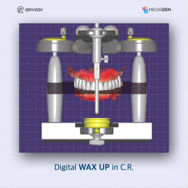 Цифровой wax-up в виртуальном артикуляторе